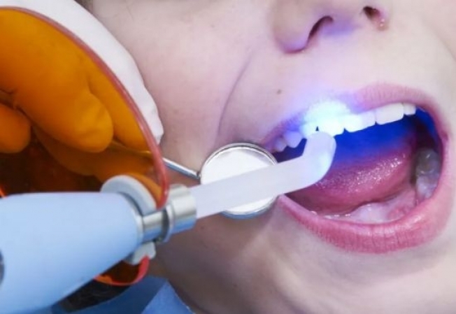 Установка пломб в государственных стоматологиях Югры станет бесплатной