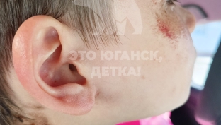 В Нефтеюганске ребенок получил химический ожог на детской площадке