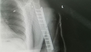 Сургутские врачи пересадили нерв из ноги в плечо